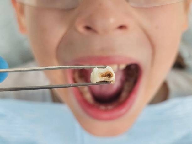 Best Emergency Wisdom Tooth Extraction in Mays Landing, NJ